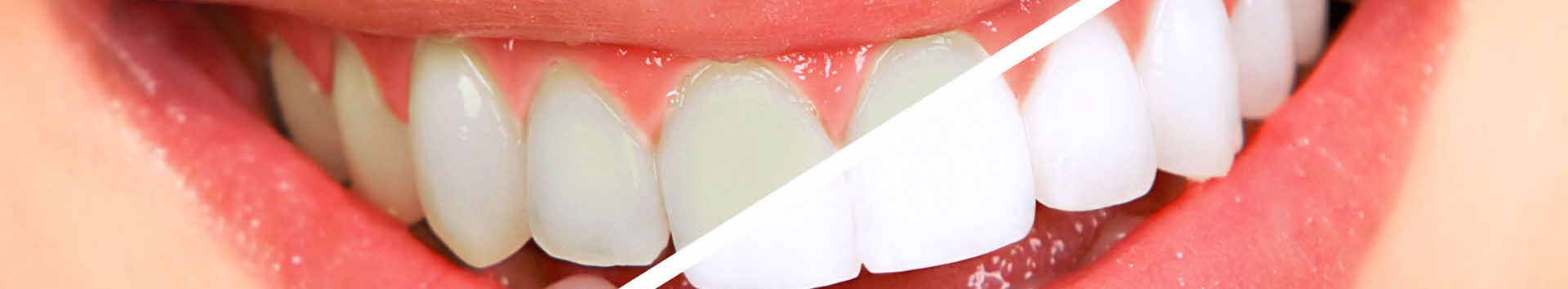Branqueamento dental: Comece o ano com dentes brancos