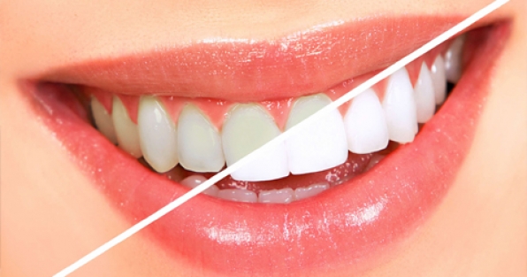 Odontologia - Branqueamento dental: Comece o ano com dentes brancos