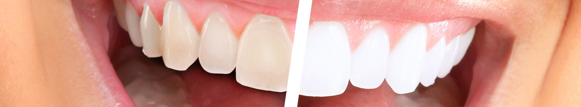 Como conservar o efeito do clareamento dental?