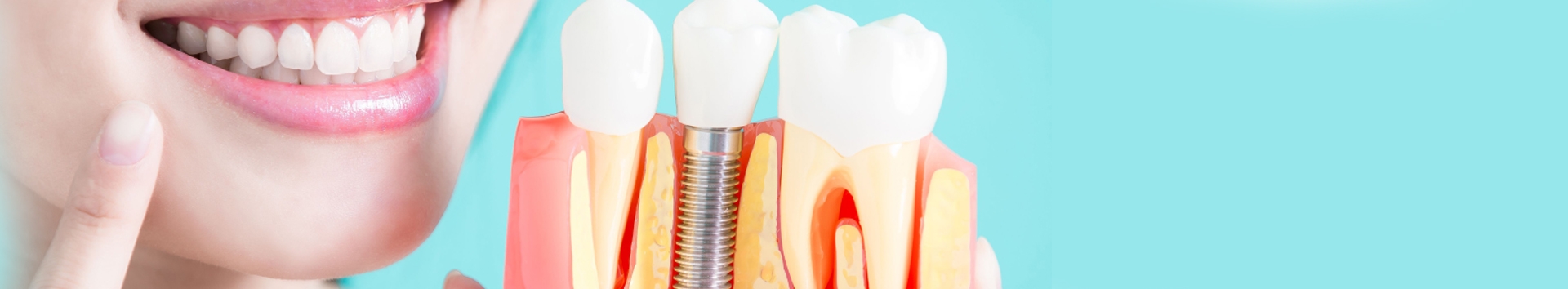 Enxerto ósseo para implante dentário: O que é, tipos e função