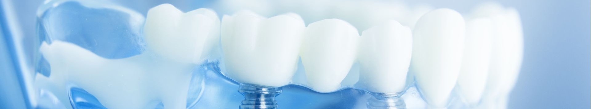 Implante dental: Como escolher o melhor implantodontista?