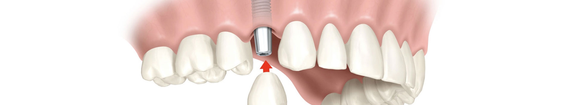 Implante dentário: Invista com segurança e ganhe um novo sorriso