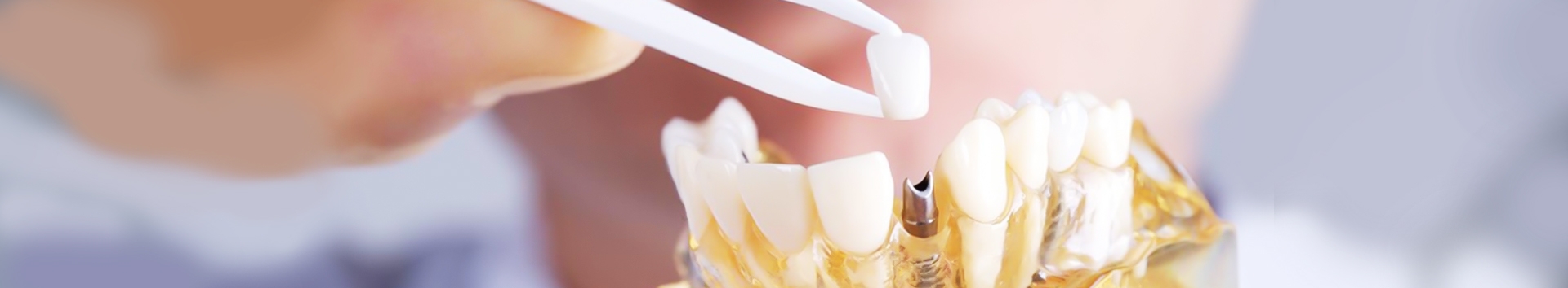Implante dentário na clínica odontológica errada causa mau hálito