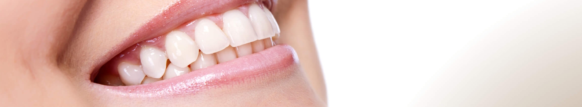 Lentes de Contato Dental: As vantagens de fazer na Dual Clinic