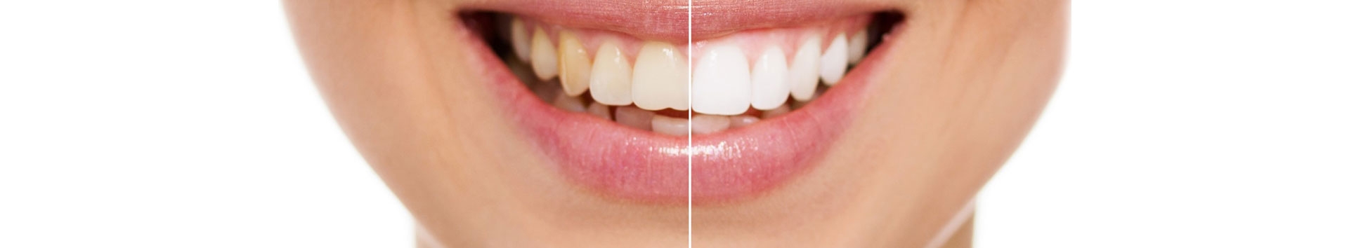 Quais os casos de restrição ao clareamento dentário?