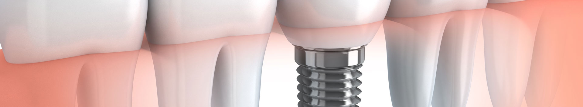 Que cuidados devo ter com o implante dental?